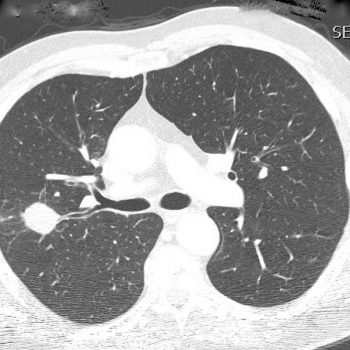 Lung Nodules and Masses Treatment