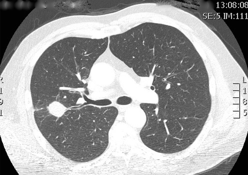 Lung Nodules and Masses Treatment