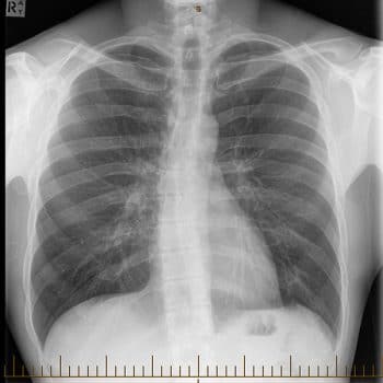Pulmonary Fibrosis Treatment