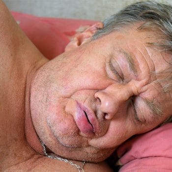 Obstructive sleep apnoea